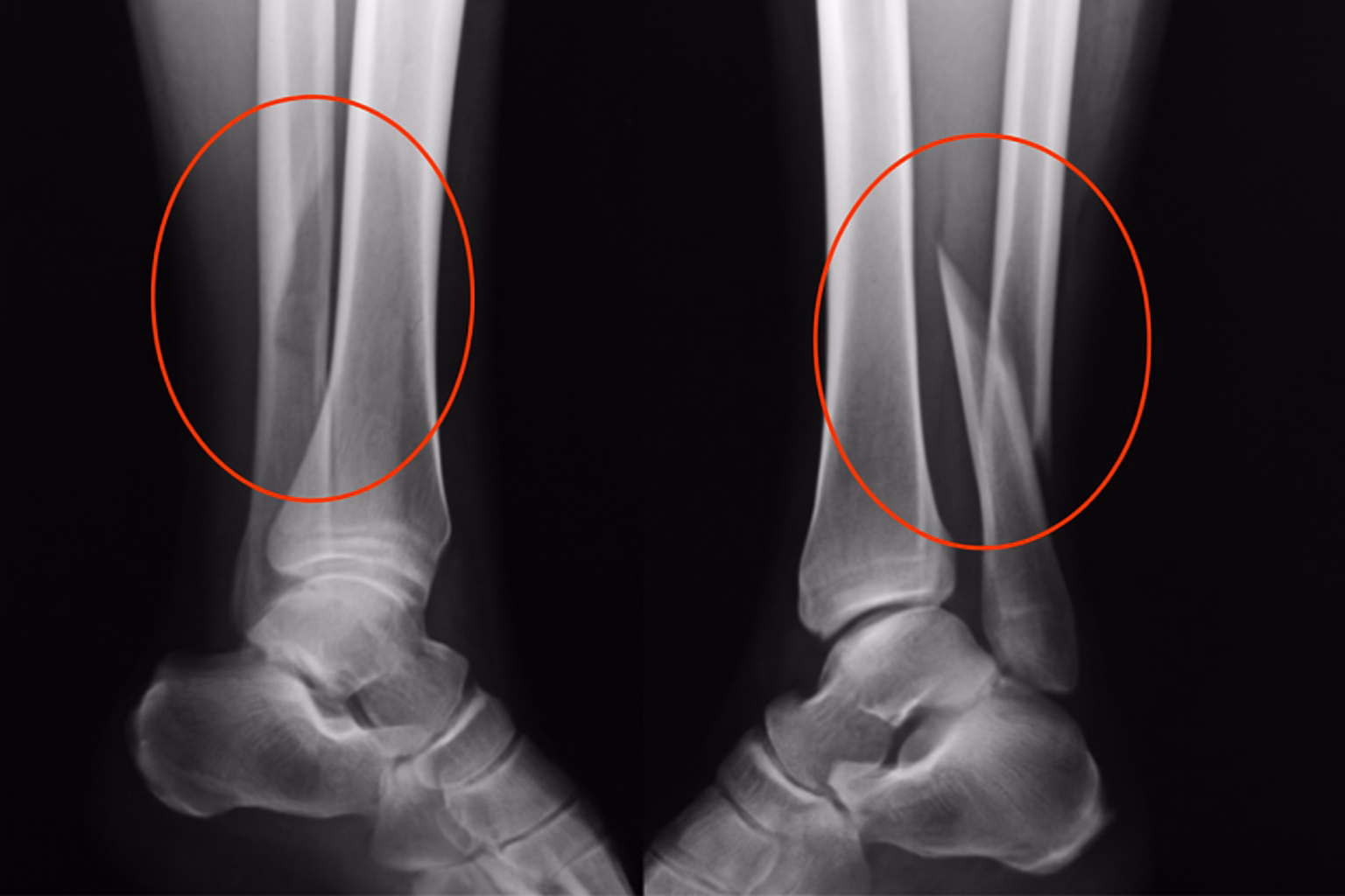 Lesões de fratura de tíbia e fíbula - ilustração médica mostrando lesões ósseas, sequelas e complicações